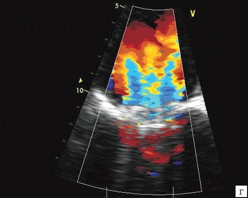 ЭхоКГ изображение двустворчатого протеза в митральной позиции с цветным картированием транспротезного потока