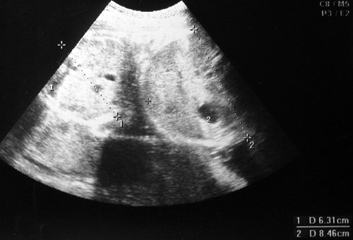 Эхограмма - дискордантный рост монозиготных близнецов, поперечные сечения туловищ плодов (беременность 35-36 недель) 