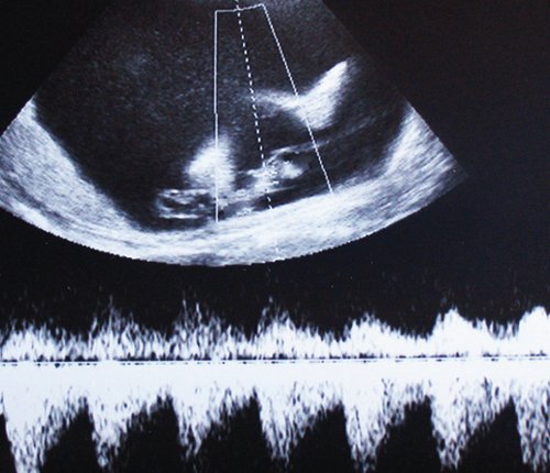 Спектральная допплерограмма пуповинных артериий плода-реципиента сохраняется даже на фоне его терминального состояния, вплоть до внутриутробной гибели, выраженный полигидрамнион