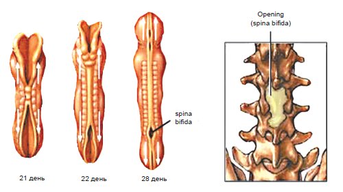 Схема - формирование дефекта нервной трубки (spina bifida)