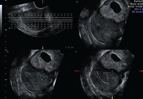 Эхограмма - визуализируется связь полости матки с полостью образования (режим Multi-Slice View)