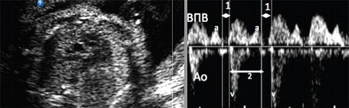 Артериально-венозная импульсно-волновая допплерография восходящей аорты (Ао) и верхней полой вены (ВПВ)