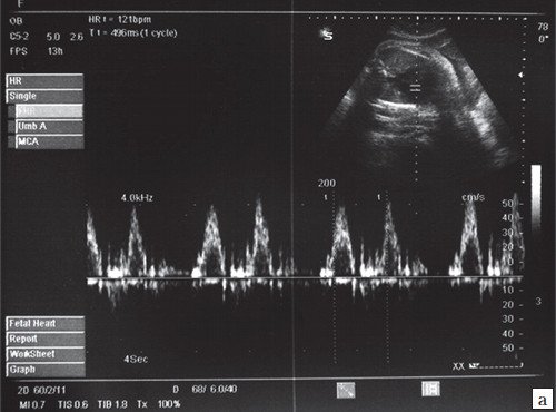 Импульсно-волновая допплерография - регистрация сокращений предсердий при предсердной бигеминии (беременность 28 недель)