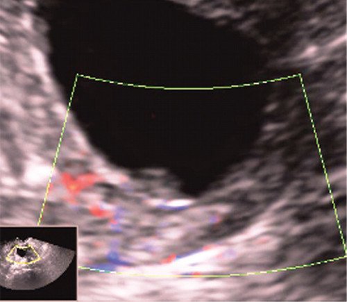 Мелкий полип эндометрия на фоне эхонегативной контрастной среды в ходе эхогистероскопии