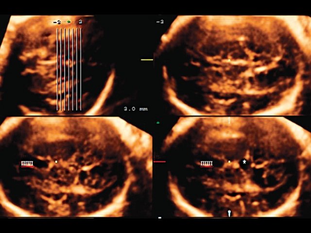 Томографический ультразвуковой режим, позволяющий оценить на ряде стандартных аксиальных срезов соотношение ППП, третьего желудочка и полученного образования