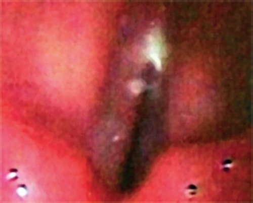 Эндоскопия гортани - сгусток слизи на правой голосовой складке