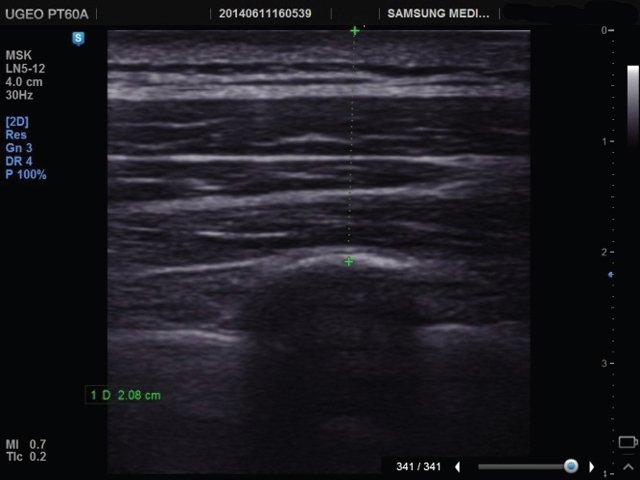 Ультразвуковое сканирование для безопасного проведения инъекции в ромбовидные мышцы - изображение в парасагиттальной плоскости, с измерением глубины до реберной кости