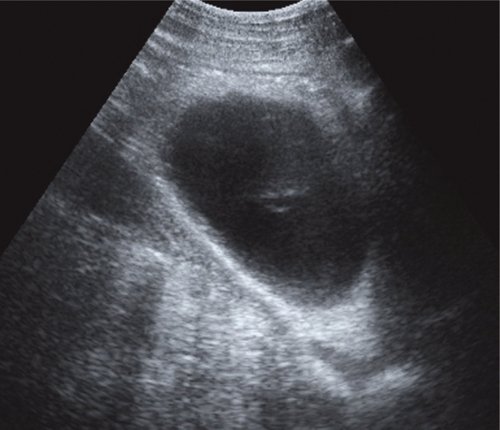 Эхограмма - псевдокисты поджелудочной железы во II и III стадиях развития, в левом подреберье жидкостное образование с капсулой более 3 мм