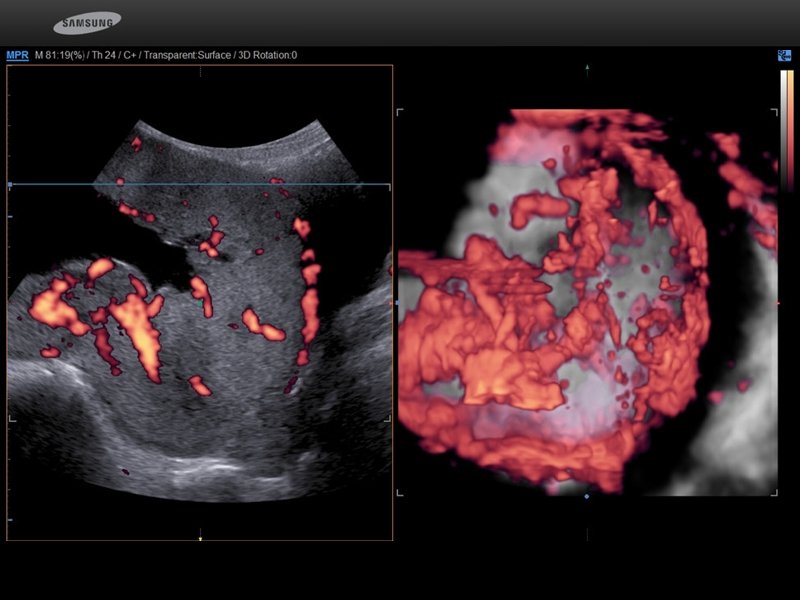 УЗИ матки при прорастании плаценты (энергетический допплер, слева B-режим, справа - 3D)