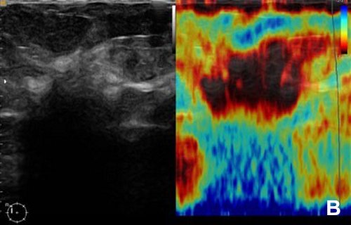 УЗИ молочной железы - инвазивная дольковая карцинома с ультразвуковой тенью позади опухоли (слева B-режим, справа эластограмма)