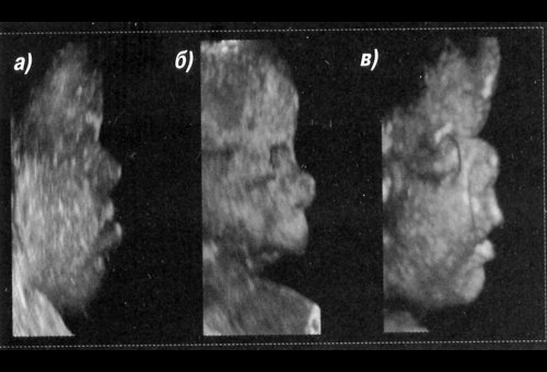 Изображения лица плода при патологии: a - синдром Дауна, б - микрогнатия, в - синдром Апера