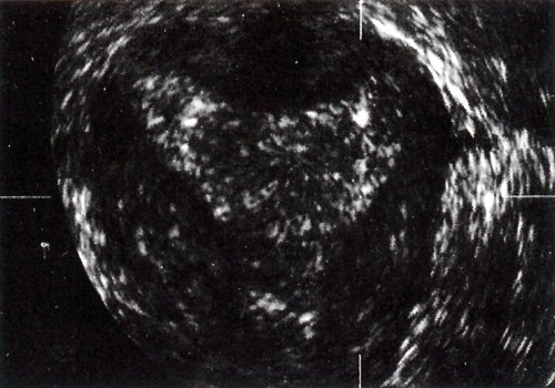 Дугообразная матка, которая отличается нормальным внешним контуром и округлой вогнутой полостью матки