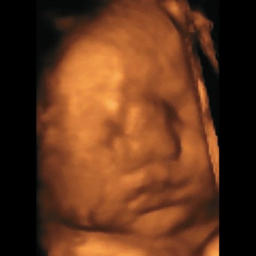Эхограмма - пренатальный фенотип ФНД в 34 нед беременности (клинический случай 1)