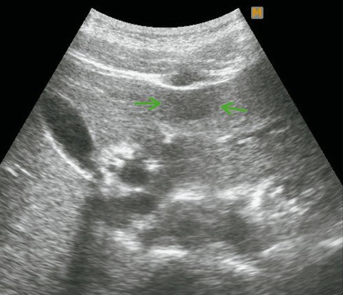 Ультразвуковая картина ФНГ печени у пациентки Г: В-режим, в левой доле печени, в III сегменте, подкапсульно визуализируется гипоэхогенное образование размерами 28 х 16 мм, с четкими ровными контурами