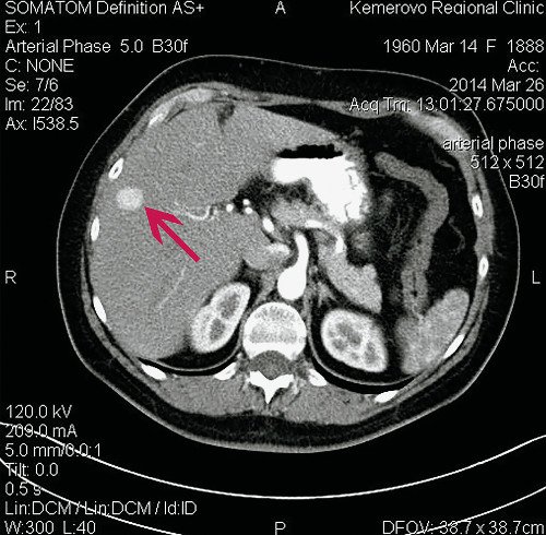 Компьютерная томограмма ФНГ печени у пациентки Р: артериальная фаза
