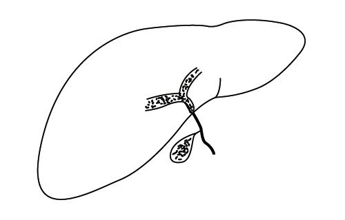 Схематическое изображение атрезии желчных протоков: внепеченочная