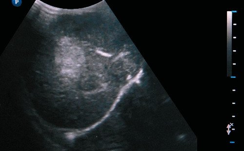 Эхографическое изображение опухоли печени (стрелка)