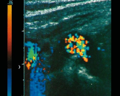 Ультразвуковая картина гемангиомы печени: при допплерографии хорошо прослеживается беспорядочный вихреобразный кровоток