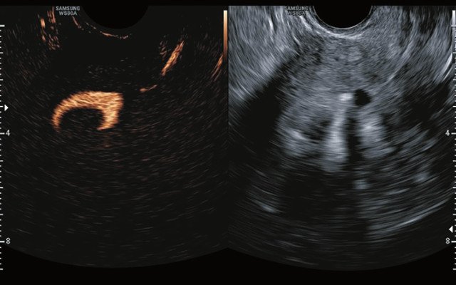Миома матки с субмукозным расположением узла - режим 2D-contrast ЭхоГСГ