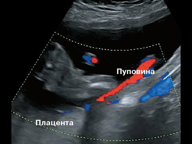 Наблюдение №2 - картина фиксированного пристеночного типа ОПП, беременность 21–26 нед
