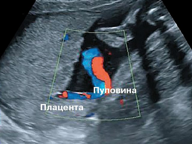Наблюдение №4 - картина фиксированного пристеночного типа ОПП, беременность 21–26 нед