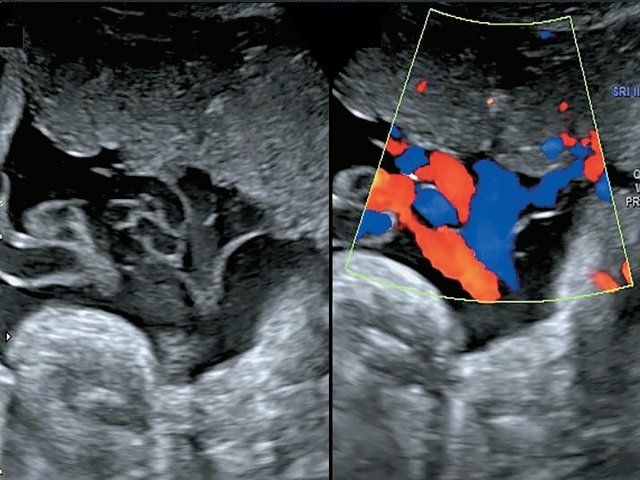 Наблюдение №6 - отображено прикрепление к поверхности плаценты расщепленных свободно расположенных сосудов пуповины, беременность 36,2 нед