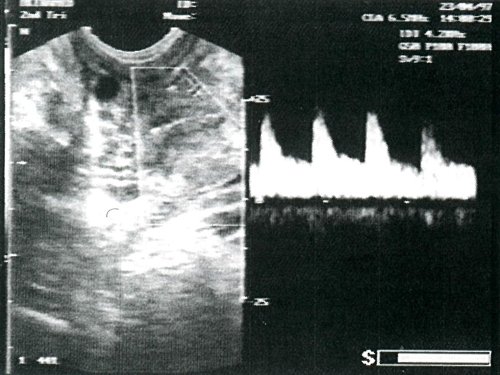 ТРУЗИ - кровоток в маточной артерии девочки в период препубертата