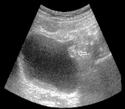 Ультразвуковая полицистограмма при опухоли мочевого пузыря (стрелка) стадии Т3 (б)