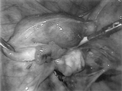 Лапароскопическая картина - прогрессирующая левосторонняя трубная беременность сроком 5 нед (до сальпинготомии)