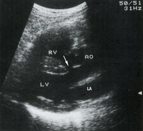 УЗ-сканирование по длинной оси у новорожденного - аорта (AO) расширена и смещена, полость левого желудочка (LV) увеличена, правый желудочек (RV) небольших размеров, LA - левое предсердие, стрелка - дефект межжелудочковой перегородки