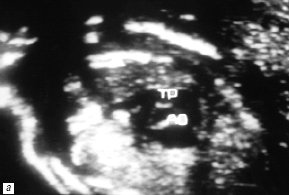 В-сканирование сердца плода на 20-й неделе гестации - проекция выводного отдела левого желудочка (TP - легочная артерия, Ao - аорта)