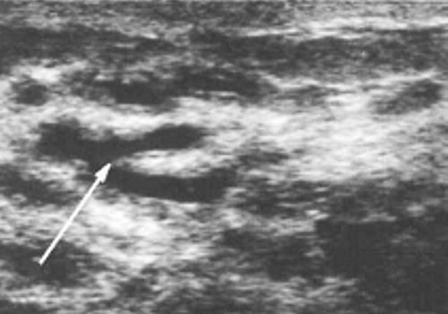 Эхограмма: молочная железа пациентки 24 лет на 10-е сутки после родов при гипогалактии (стрелками обозначены расширенные протоки в ареолярной области, окруженные перигландулярной стромой)