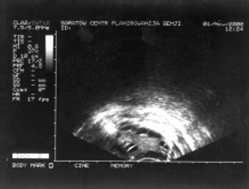 Эхографическая картина яичника при овариальной гиперандрогении (а)