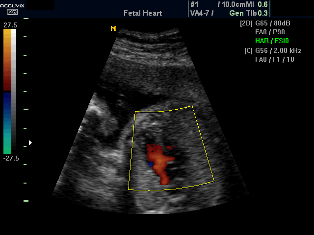 Fetal heart, color doppler (echogramm №387)