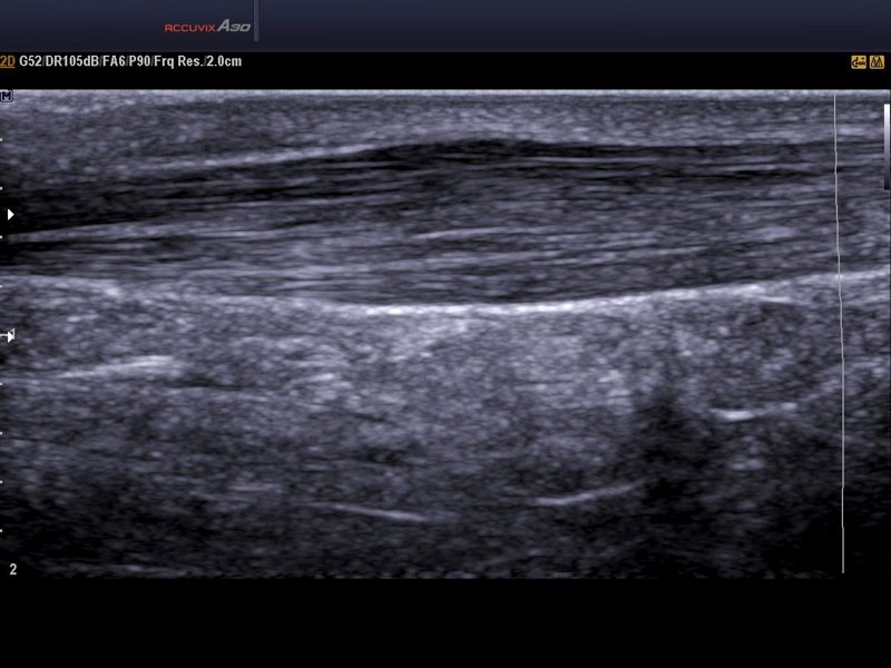 Achilles tendon, B-mode (echogramm №591)