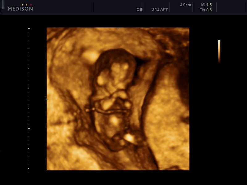 Fetus - 12 weeks, 3D (echogramm №608)
