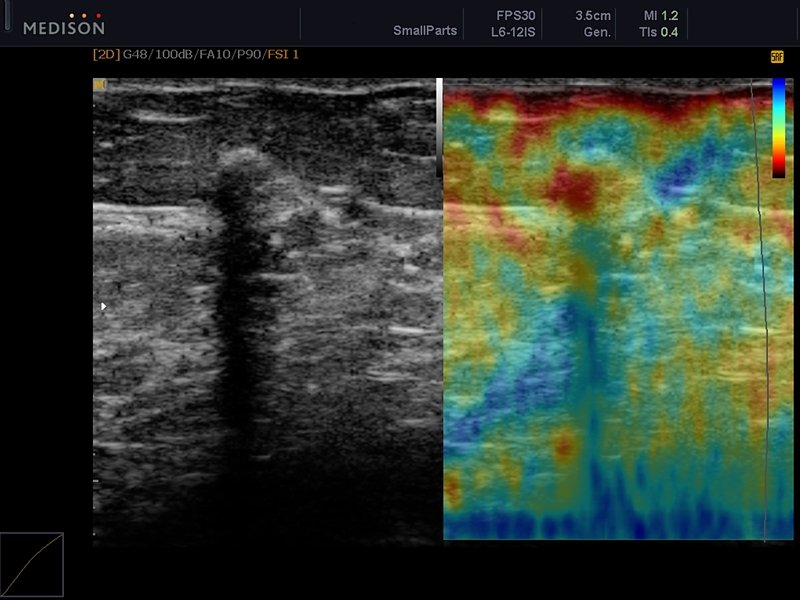 Breast - calcified oil cyst, elastography (echogramm №613)