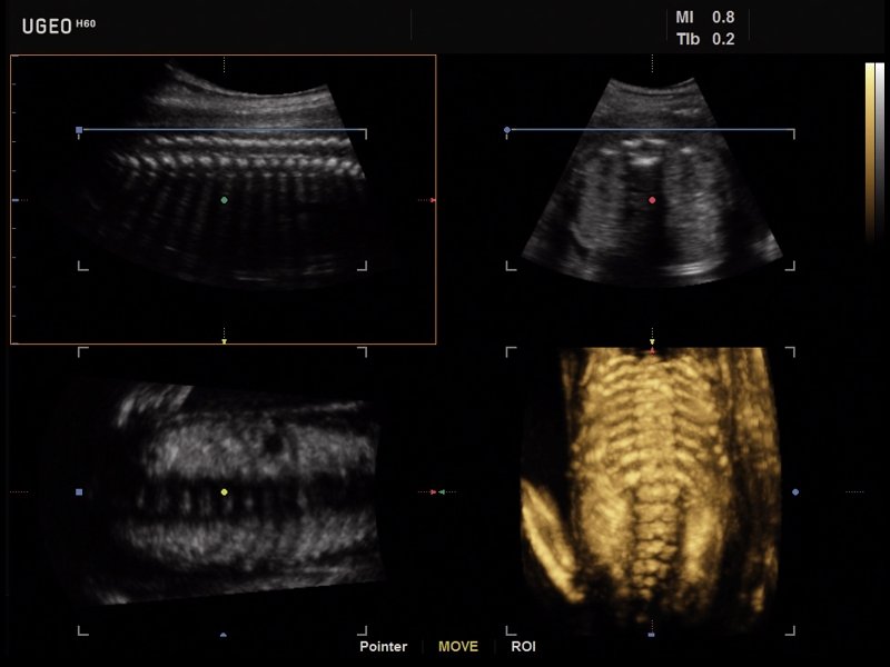 Fetal spine, MPR & 3D (echogramm №628)