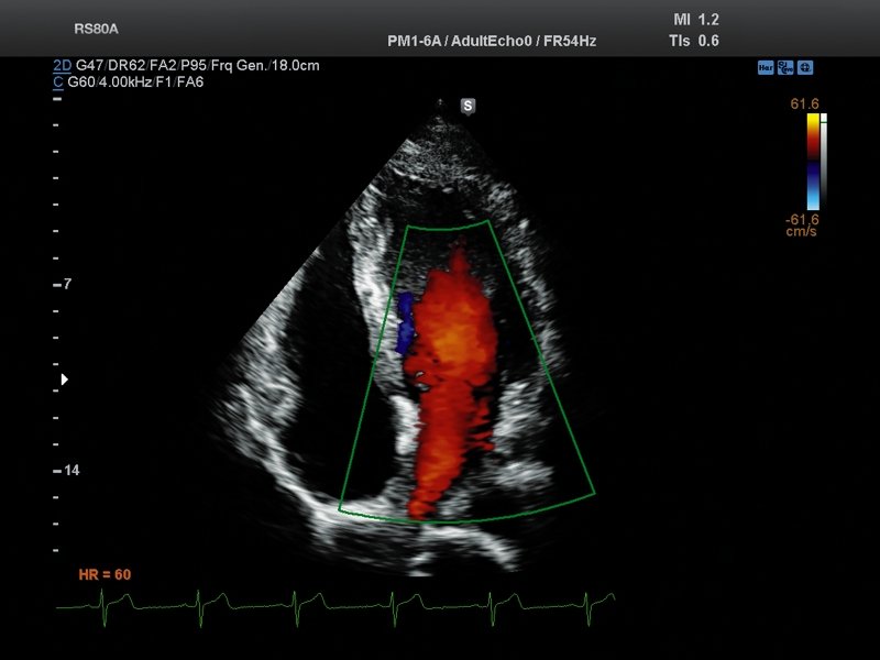 Heart (apical 4 chamber view), color doppler (echogramm №689)