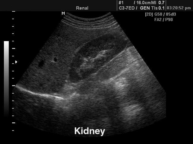 Kidney, B-mode (echogramm №107)