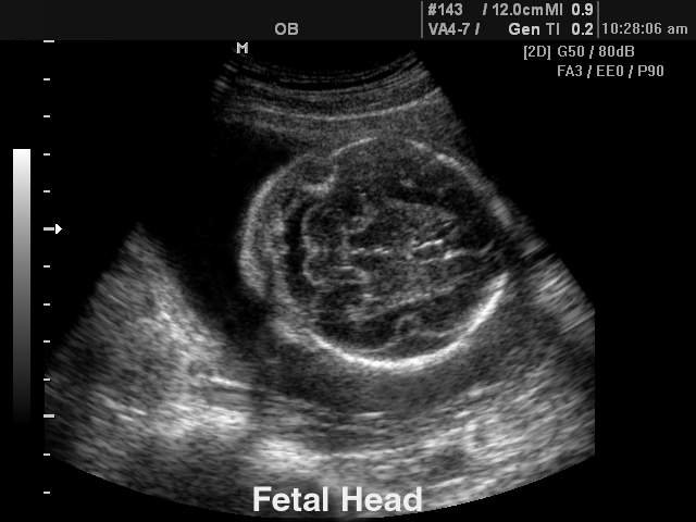 Fetal brain, B-mode (echogramm №119)