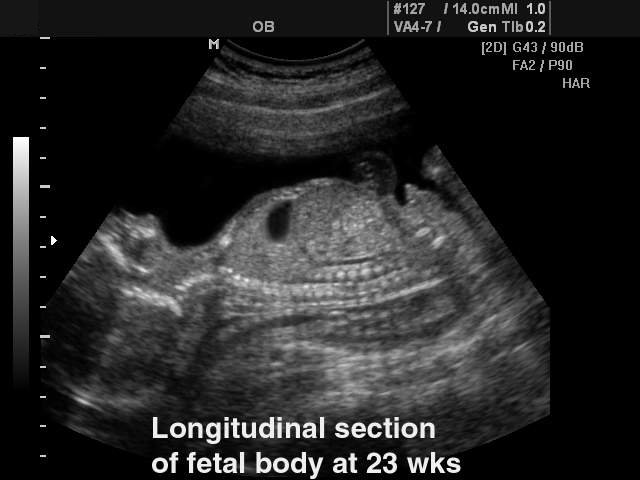 Fetus - 23 week, B-mode (echogramm №124)