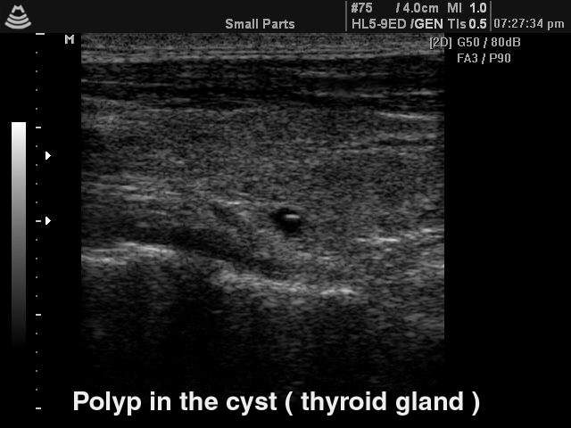 Thyroid polyp in the cyst, B-mode (echogramm №140)