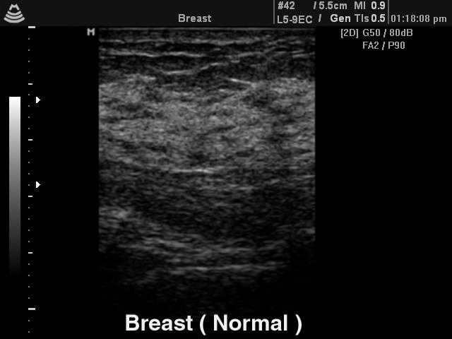 Breast - norm, B-mode (echogramm №144)