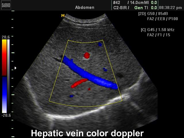 Hepatic vein, color doppler (echogramm №150)