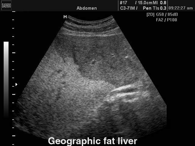 Liver steatosis, B-mode (echogramm №153)