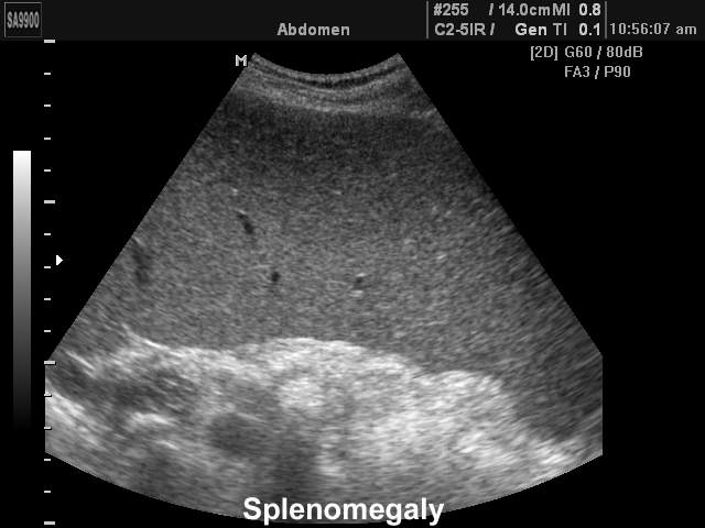 Spleen - splenomegaly, B-mode (echogramm №160)