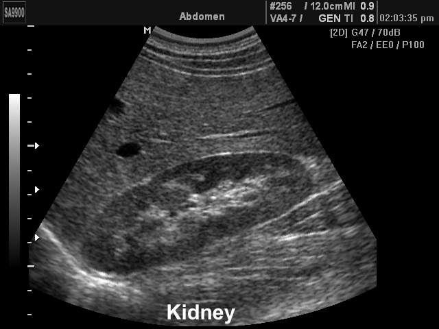 Kidney, B-mode (echogramm №162)