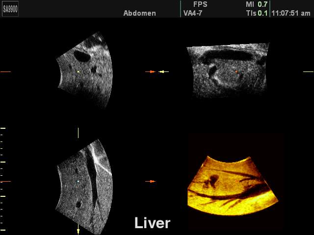Liver, 3D reconstruction (echogramm №167)