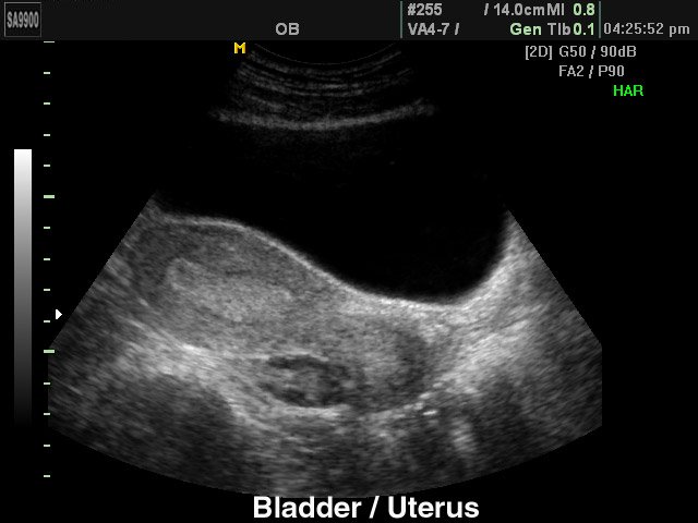 Uterrus and bladder, B-mode (echogramm №190)